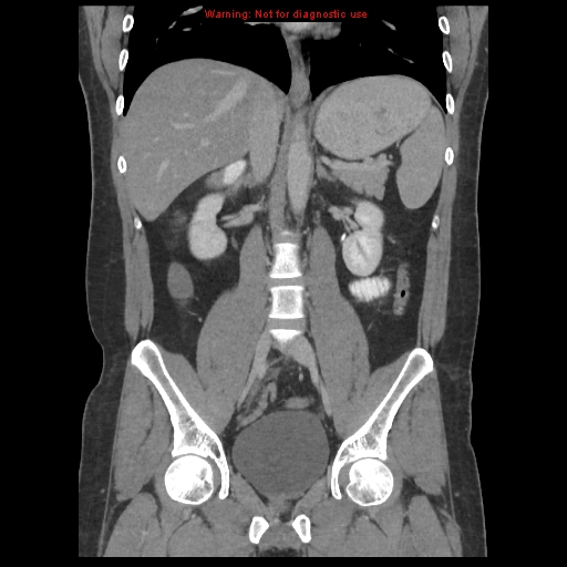File:Acute appendicitis (Radiopaedia 10498-10973 F 24).jpg
