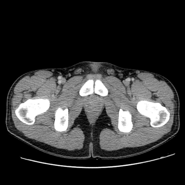 Acute appendicitis (Radiopaedia 27049-27227 Axial C+ portal venous phase 79).jpg