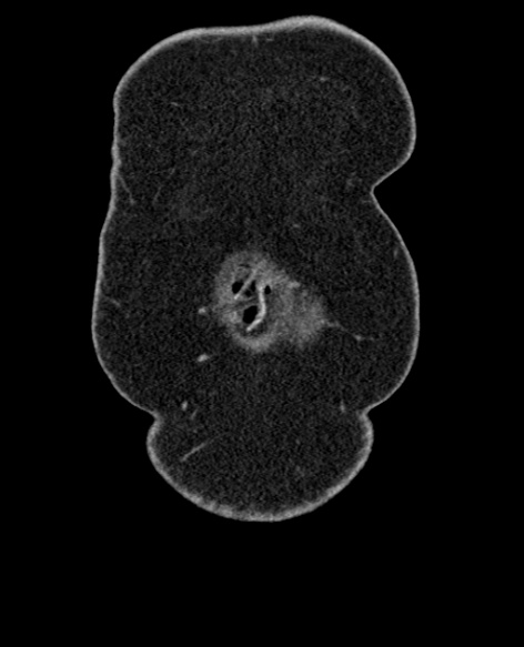 File:Acute appendicitis (Radiopaedia 48792-53822 Coronal C+ portal venous phase 11).jpg