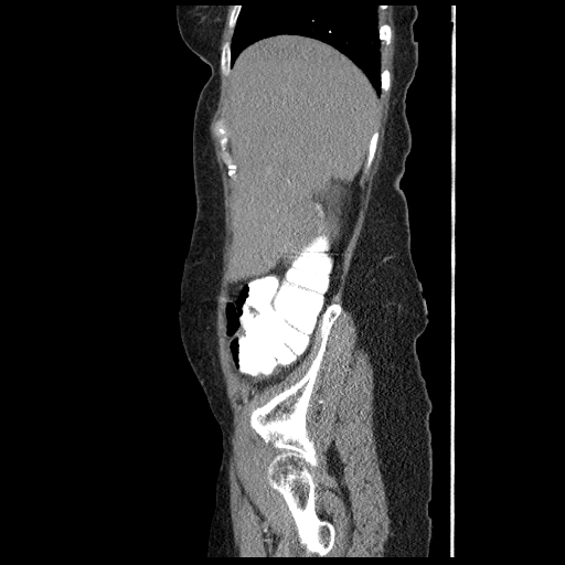 File:Acute appendicitis (Radiopaedia 52672-58589 Sagittal C+ arterial phase 15).jpg