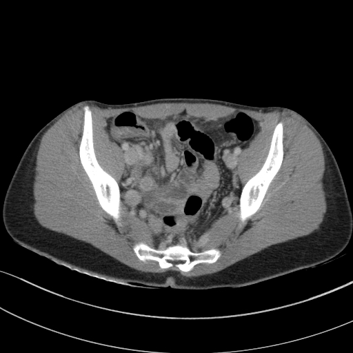 Acute appendicitis (Radiopaedia 62608-70901 Axial C+ portal venous phase 31).jpg