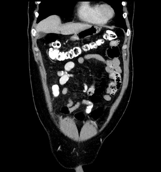 Acute appendicitis (Radiopaedia 77016-88960 Coronal C+ portal venous phase 29).jpg