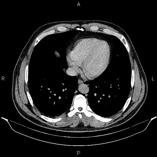 File:Acute appendicitis (Radiopaedia 84780-100240 Axial C+ portal venous phase 6).jpg