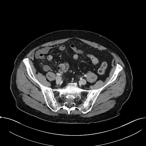 Acute appendicitis - large appendicoliths (Radiopaedia 61805-69820 Axial C+ portal venous phase 97).jpg