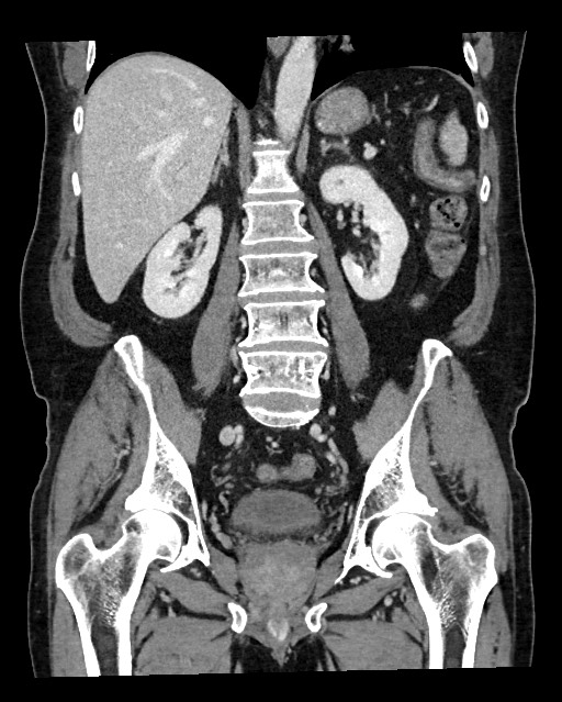 Acute appendicitis - large appendicoliths (Radiopaedia 61805-69820 Coronal C+ portal venous phase 83).jpg