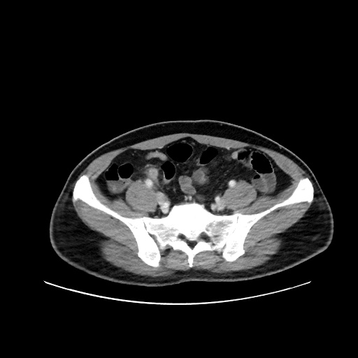 File:Acute appendicitis and COVID 19 pneumonia (Radiopaedia 76604-88380 Axial C+ portal venous phase 63).jpg