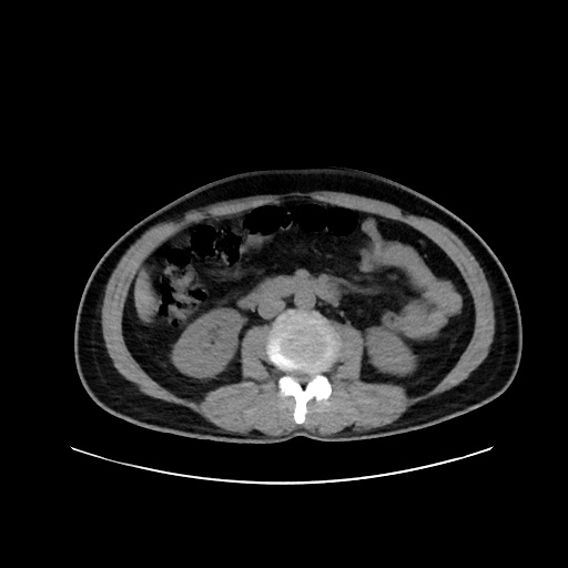 File:Acute appendicitis and COVID 19 pneumonia (Radiopaedia 76604-88380 Axial non-contrast 75).jpg