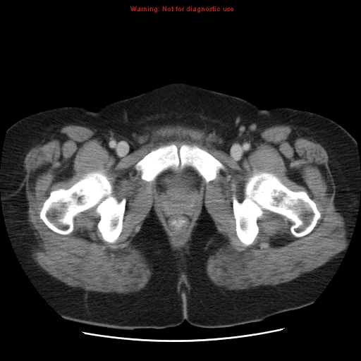Acute appendicitis complicated by ovarian vein thrombophlebitis (Radiopaedia 16172-15851 Axial C+ portal venous phase 87).jpg