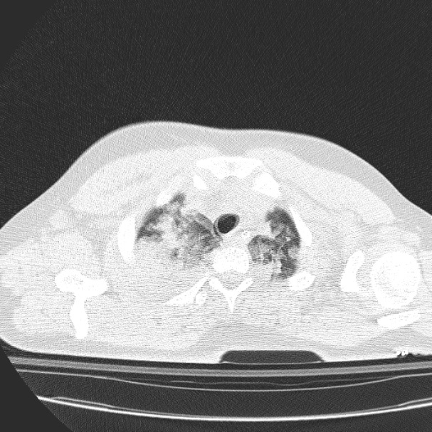 Acute aspiration pneumonitis (Radiopaedia 33605-34703 Axial lung window 19).jpg