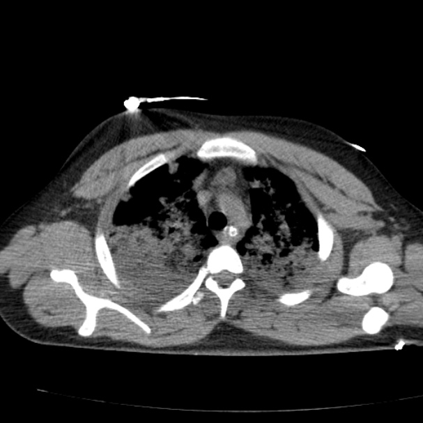 Acute aspiration pneumonitis (Radiopaedia 33605-34703 Axial non-contrast 30).jpg