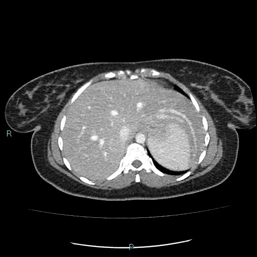 Acute bilateral pyelonephritis (Radiopaedia 37146-38881 Axial C+ portal venous phase 13).jpg