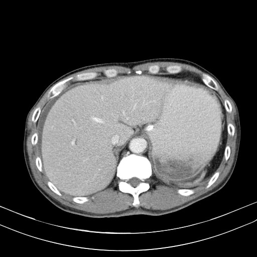 Acute bowel ischemia (Radiopaedia 87695-104114 Axial C+ portal venous phase 18).jpg
