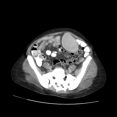 Acute calculous cholecystitis in patient with osteopetrosis (Radiopaedia 77871-90159 Axial C+ portal venous phase 61).jpg