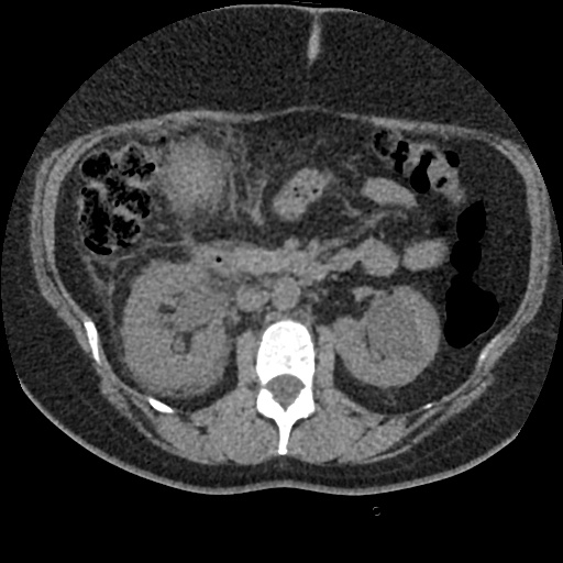 Acute cholecystitis and ureteric colic (Radiopaedia 42330-45444 Axial prone 38).jpg