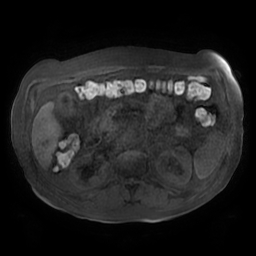 Acute cholecystitis complicated by pylephlebitis (Radiopaedia 65782-74915 Axial T1 fat sat 68).jpg