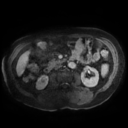 Acute cholecystitis complicated by pylephlebitis (Radiopaedia 65782-74915 Axial arterioportal phase T1 C+ fat sat 90).jpg