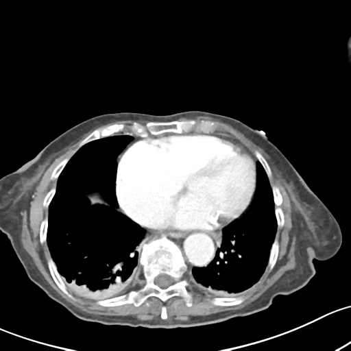 File:Acute cholecystitis with contained perforation (Radiopaedia 47328-51907 Axial C+ portal venous phase 2).png