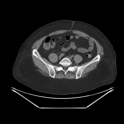 Acute cholecystitis with tensile fundus sign (Radiopaedia 71394-81723 Axial non-contrast 79).jpg