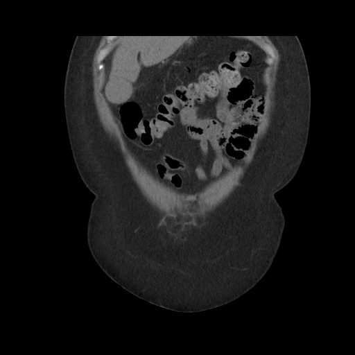 Acute cholecystitis with tensile fundus sign (Radiopaedia 71394-81723 Coronal non-contrast 31).jpg