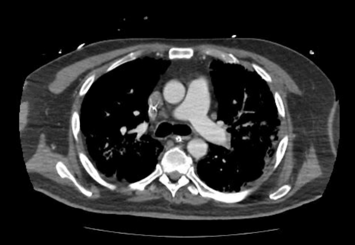 Acute cor pulmonale (ultrasound) (Radiopaedia 83508-98818 Axial C+ CTPA 29).jpg