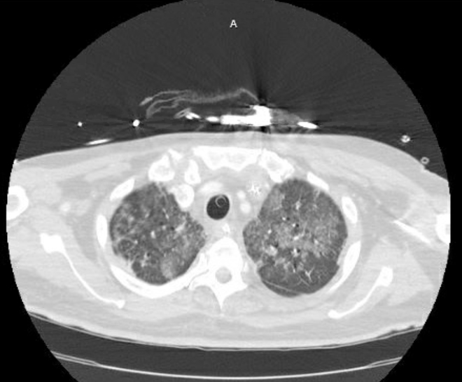 Acute cor pulmonale (ultrasound) (Radiopaedia 83508-98818 Axial lung window 17).jpg