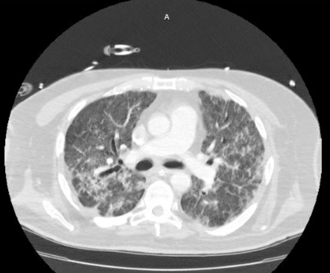 Acute cor pulmonale (ultrasound) (Radiopaedia 83508-98818 Axial lung window 39).jpg