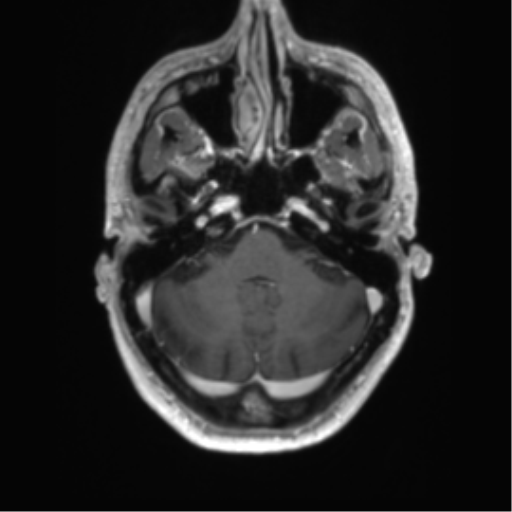 Acute disseminated encephalomyelitis (ADEM) (Radiopaedia 65319-74350 Axial T1 C+ 9).png