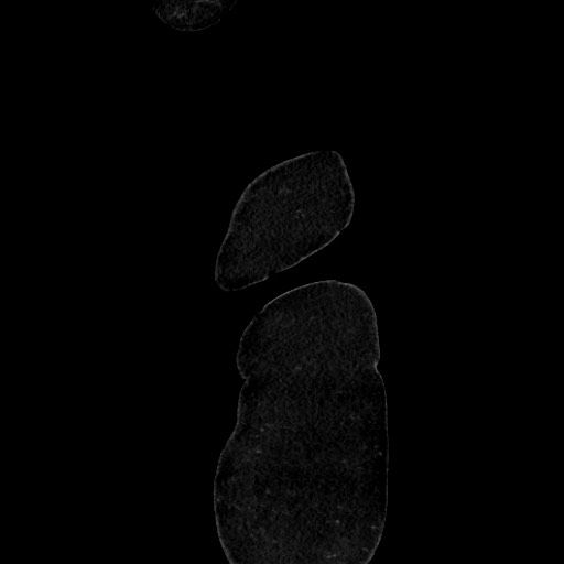 Acute diverticulitis - transverse colon (Radiopaedia 87063-103327 Sagittal C+ portal venous phase 17).jpg