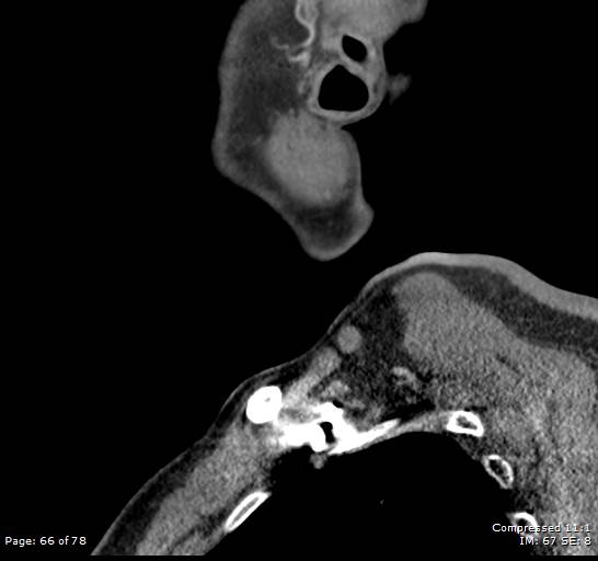 Acute epiglottitis (Radiopaedia 54375-60590 Sagittal C+ arterial phase 66).jpg
