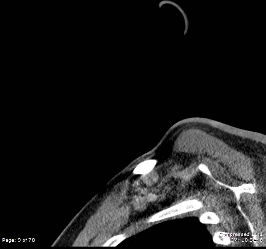 Acute epiglottitis (Radiopaedia 54375-60590 Sagittal C+ arterial phase 9).jpg