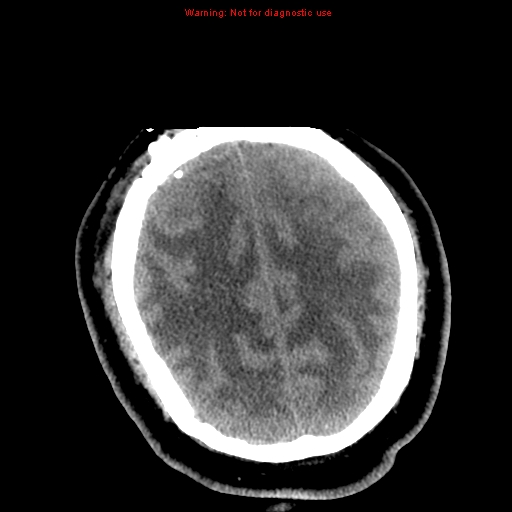 File:Acute hemorrhagic leukoencephalitis (Radiopaedia 14076-72275 Axial non-contrast 33).jpg
