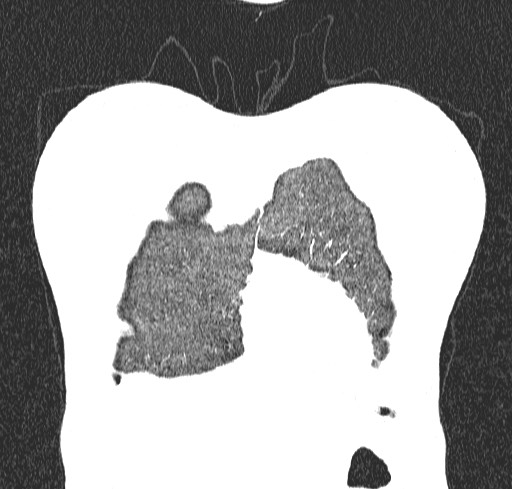 File:Acute hypersensitivity pneumonitis (Radiopaedia 85293-100870 Coronal lung window 7).jpg