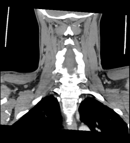 Acute longus colli calcific tendinitis (Radiopaedia 72495-83036 Coronal C+ arterial phase 48).jpg