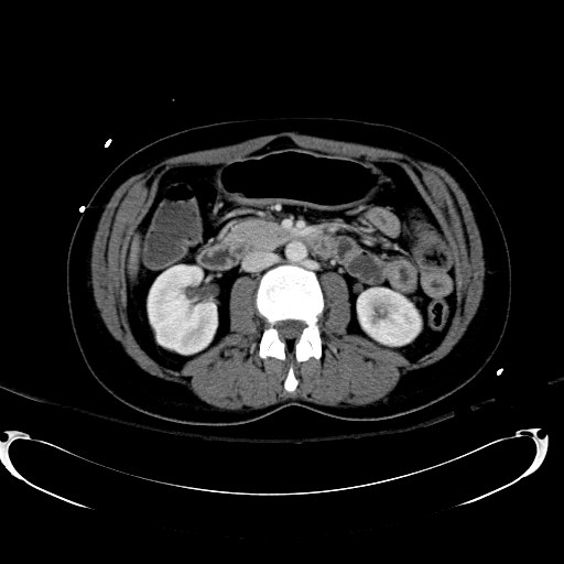 Acute myocardial infarction in CT (Radiopaedia 39947-42415 Axial C+ portal venous phase 58).jpg