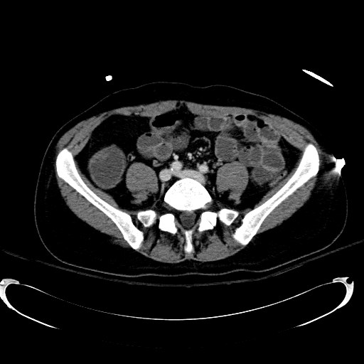 File:Acute myocardial infarction in CT (Radiopaedia 39947-42415 Axial C+ portal venous phase 88).jpg