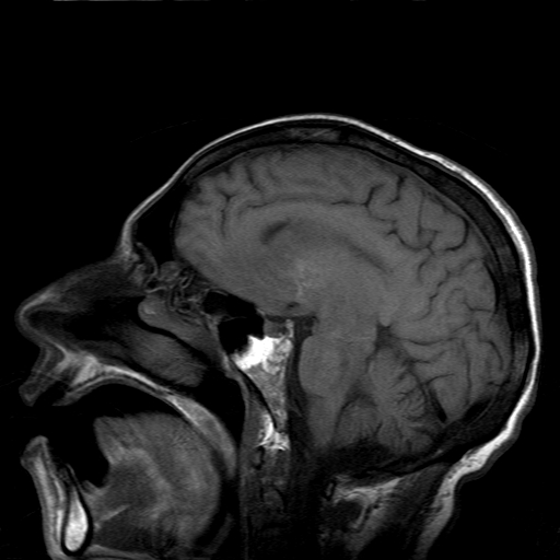 File:Acute necrotizing toxoplasma encephalitis (Radiopaedia 10683-11149 Sagittal T1 fat sat 9).jpg