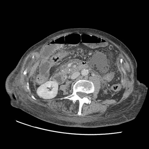 Acute on chronic pancreatitis (Radiopaedia 13233-13244 Axial C+ portal venous phase 56).jpg