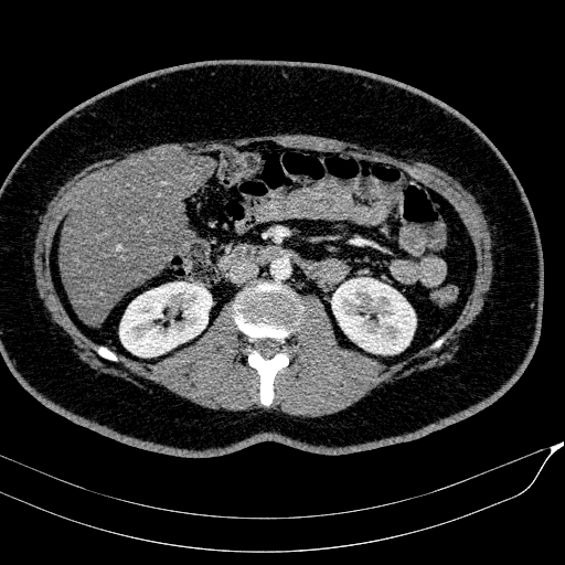 Acute on chronic pancreatitis (Radiopaedia 80902-94423 Axial C+ portal venous phase 85).jpg