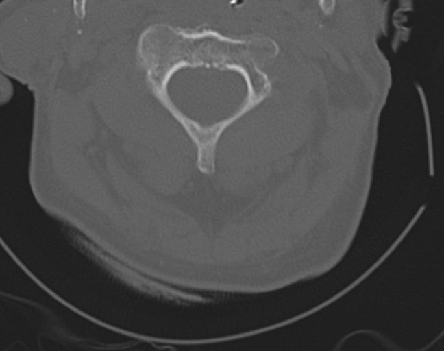 Acute on chronic subdural hematoma and thoracic vertebral injury in a multitrauma patient (Radiopaedia 31698-32619 Axial bone window 18).jpg