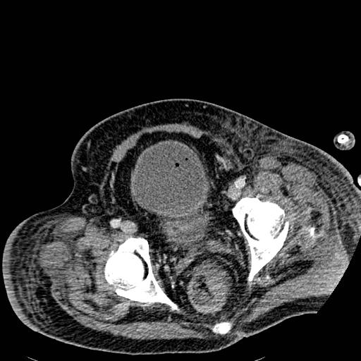 Acute pancreatic necrosis (Radiopaedia 13560-18501 Axial C+ portal venous phase 137).jpg