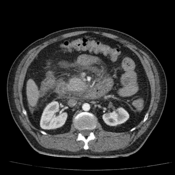 Acute pancreatitis (Radiopaedia 26663-26813 Axial C+ arterial phase 44).jpg