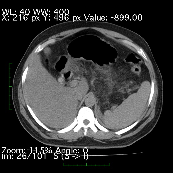 Acute pancreatitis (Radiopaedia 34043-35276 Axial non-contrast 26).jpg