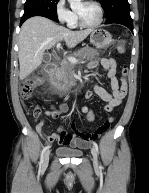 Acute pancreatitis - Balthazar E (Radiopaedia 23080-23110 Coronal C+ portal venous phase 31).jpg