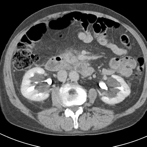 File:Acute pancreatitis and walled-off necrosis (Radiopaedia 29888-30403 Axial C+ delayed 40).jpg