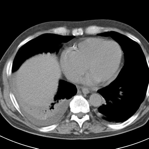 File:Acute pancreatitis and walled-off necrosis (Radiopaedia 29888-30403 Axial non-contrast 1).jpg