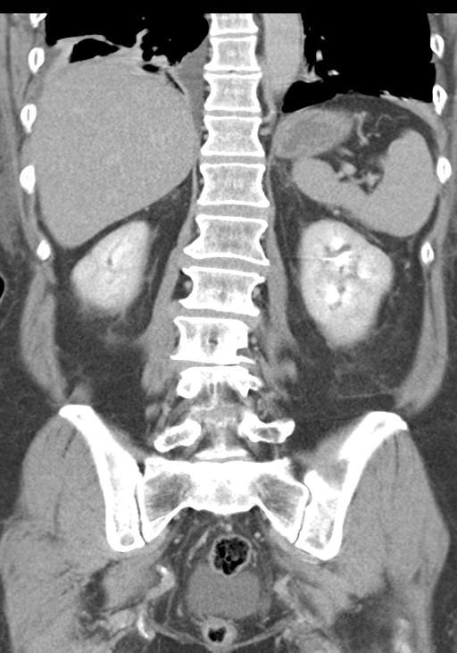 Acute pancreatitis and walled-off necrosis (Radiopaedia 29888-30403 E 41).jpg