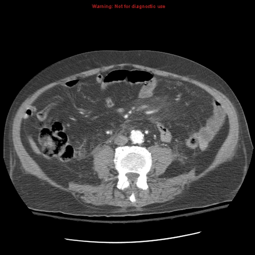 Acute pancreatitis with incidental pancreatic lipoma (Radiopaedia 10190-10730 Axial C+ arterial phase 64).jpg
