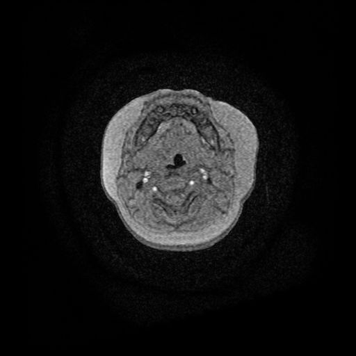 Acute phase of hemiconvulsion-hemiplegia epilepsy syndrome (Radiopaedia 29309-29745 Axial TOF angiography 188).jpg