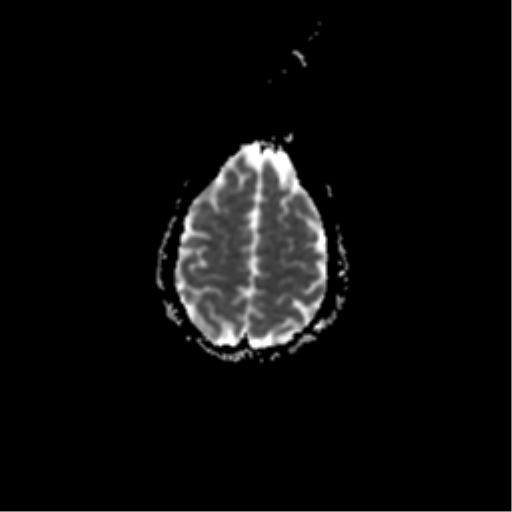 File:Acute pontine infarct from vertebral artery dissection (Radiopaedia 34111-35370 Axial ADC 19).png