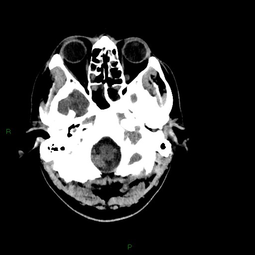 Acute posterior cerebral artery territory infarct (Radiopaedia 79329-92393 Axial non-contrast 15).jpg